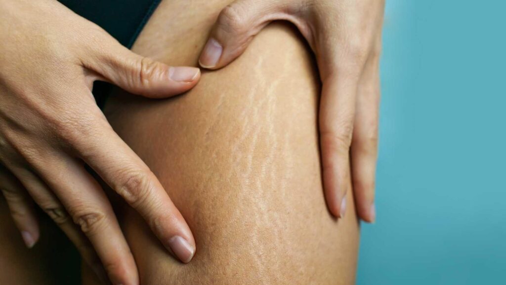 معرفی محصولات رفع ترک پوستی